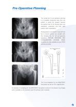 Avanteon Surgical Technique-3