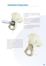 Avanteon Surgical Technique-5