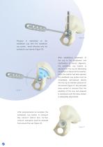Avanteon Surgical Technique-8