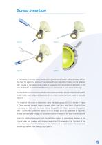 CSF Plus Surgical Technique-7