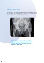 Furlong Evolution Surgical technique-6
