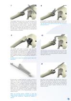 Hemiarthroplasty Surgical technique-7