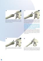 Hemiarthroplasty Surgical technique-8