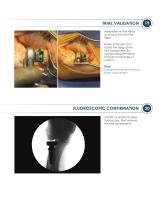 ALIGN ® Surgical Technique Guide-11