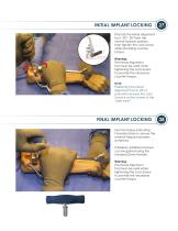 ALIGN ® Surgical Technique Guide-15