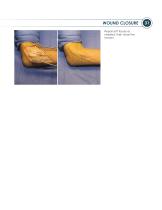 ALIGN ® Surgical Technique Guide-17