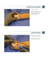ALIGN ® Surgical Technique Guide-3