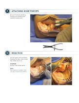 ALIGN ® Surgical Technique Guide-6