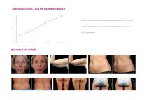 NUBWAY body contouring VS II-8