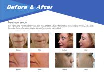 NUBWAY microneedling NBW-FR III-4