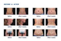 NUBWAY skin and body care CRYOTEC 360MULTI-6