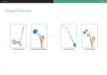 Bipolar II Cap Surgical Technique Guide - 5