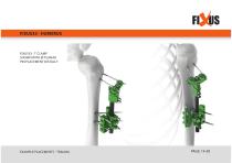 FIXUS - EXAMPLE PLACEMENTS - TRAUMA-14