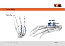 FIXUS - EXAMPLE PLACEMENTS - TRAUMA-5