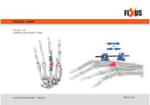 FIXUS - EXAMPLE PLACEMENTS - TRAUMA-6