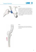 Lubinus SP II Anatomically Adapted Cemented Hip System - 11