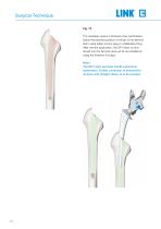 Lubinus SP II Anatomically Adapted Cemented Hip System - 12