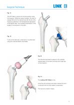 Lubinus SP II Anatomically Adapted Cemented Hip System - 13