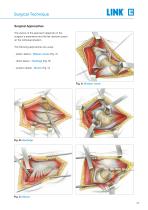 Lubinus SP II Anatomically Adapted Cemented Hip System - 7