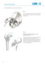 Lubinus SP II Anatomically Adapted Cemented Hip System - 8