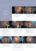 Correction de l’Incontinence Urinaire d’Effort Stress Urinary Incontinence Correction SB3 / SB4-3