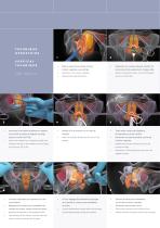 Correction de l’Incontinence Urinaire d’Effort Stress Urinary Incontinence Correction SB3 / SB4-4