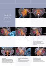 Correction de l’Incontinence Urinaire d’Effort Stress Urinary Incontinence Correction SB3 / SB4-5
