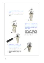 Reconstruction du Ligament Croisé Antérieur par technique Kenneth Jones ou DIDT-6