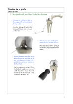 Reconstruction du Ligament Croisé Antérieur par technique Kenneth Jones ou DIDT-7