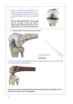 Reconstruction du Ligament Croisé Antérieur par technique Kenneth Jones ou DIDT-8