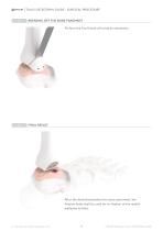 TALUS OSTEOTOMY-9