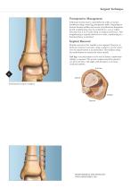 syndesmosis button surgical technique-4