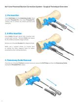 Axi+Line® Proximal Bunion Correction System-4