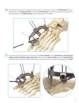 InCoreTM Lapidus System-9