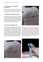 OPERATING TECHNIQUE - ACROMIOCLAVICULAR LIGAMENTOPLASTY-5