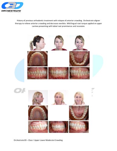 Class I Upper Lower Moderate Crowding