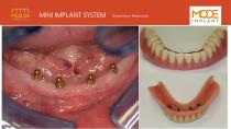 Mini Implants-13