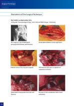 Hip Hemiarthroplasty – type CSB - 12