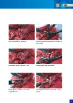 Hip Hemiarthroplasty – type CSB - 13