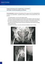 Hip Hemiarthroplasty – type CSB - 6