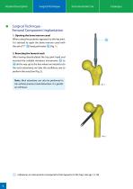 Hip Joint Stem Type BEZNOSKA TRIO - 6