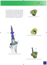 Total Knee Joint Replacement Type CMS - 11