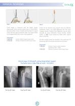 Ortholox® Locking Periprosthetic Plate System - 6