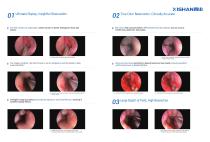 ENDOSCOPIC SYSTEM SINUSOSCOPY-3
