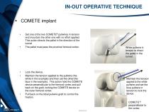 COMETE® / ECLIPSE ® AND ECLIPSE ® BCP SCREW - 13