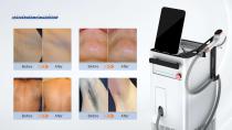 3000W Diode Laser-17