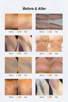 3000W Laser Hair Removal Machine HIDL-3000-13