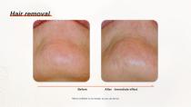 DPL PLUS Hair Removal + Filter DPL Skin Care-14