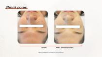 DPL PLUS Hair Removal + Filter DPL Skin Care-16