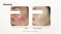 DPL PLUS Hair Removal + Filter DPL Skin Care-17